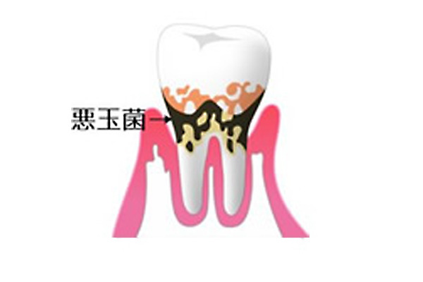 歯ぐきから血や膿が出たら、中期歯周病・歯槽膿漏の症状です