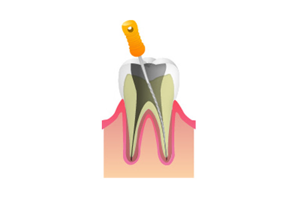 夜も眠れないくらい歯が痛くなった場合は根管治療(神経の治療)を行います。